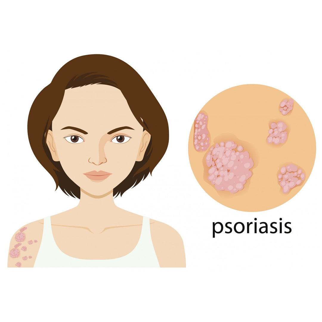 Psoriasis