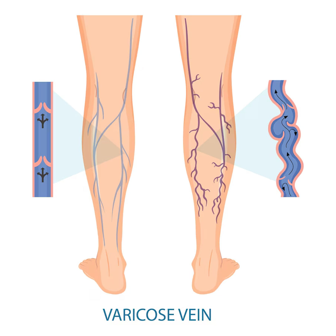 Varicose Veins